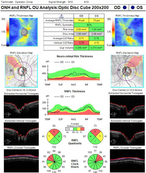 Figure 3. Optical coherence tomography of the retinal nerve fiber layer of the patient presented in Case 1.