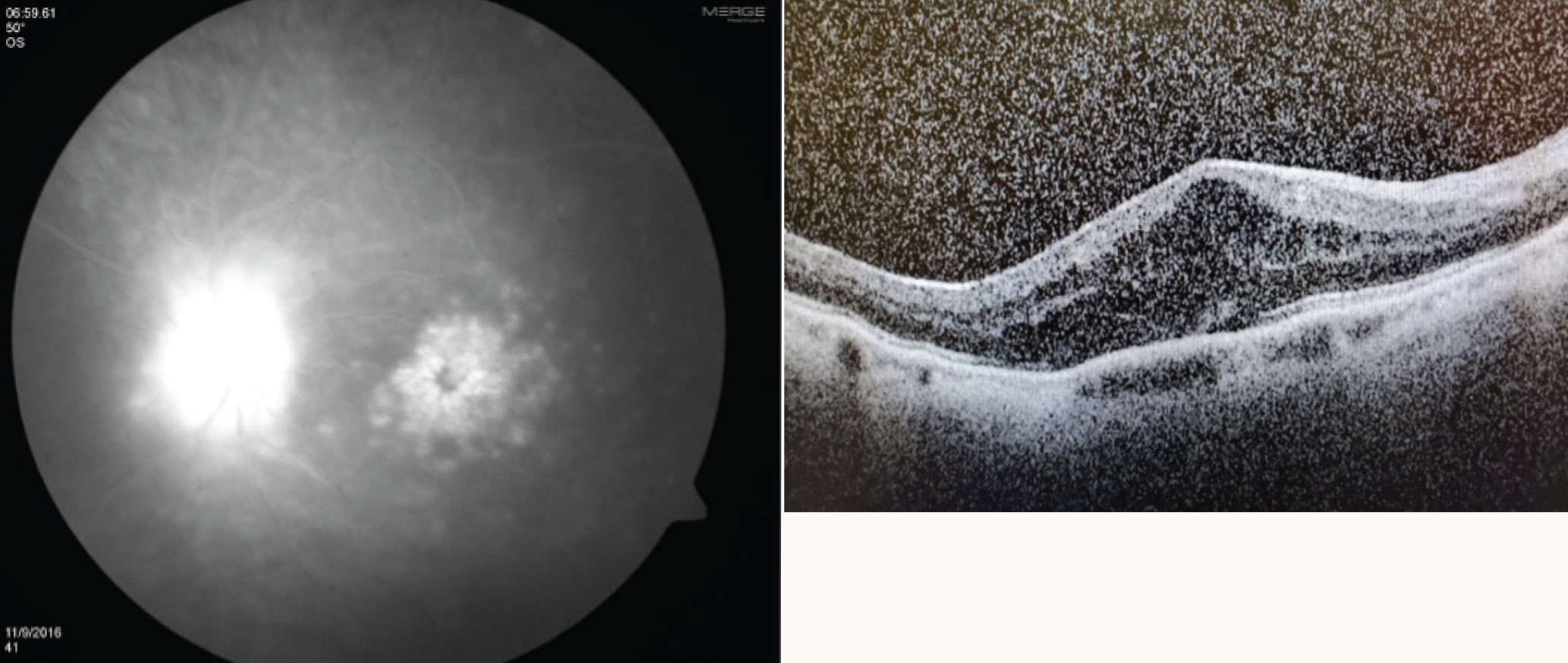 Cystoid macular edema on fluorescein angiography (left) and optical coherence tomography (right).Cystoid macular edema on fluorescein angiography (left) and optical coherence tomography (right).