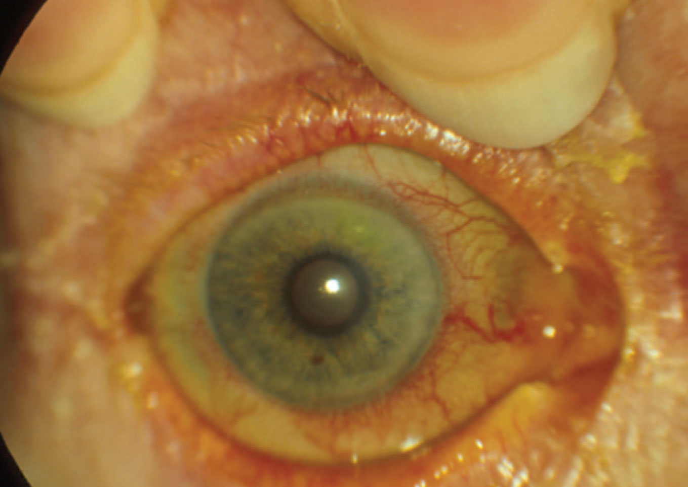 A ciliary flush is visible on examination.