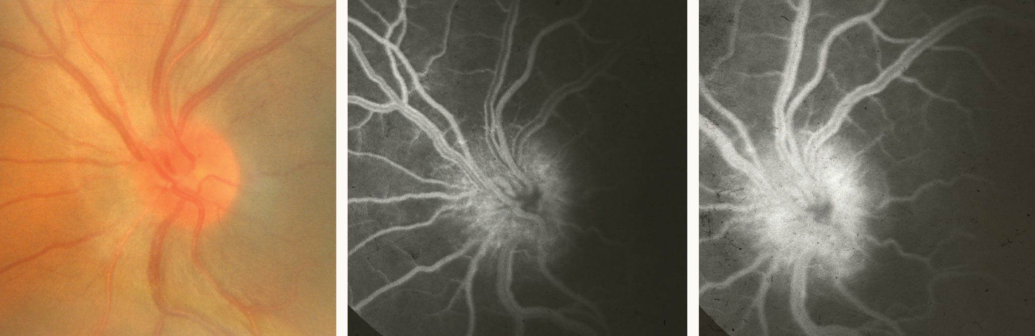 Pictured here is an HLA-B27–positive uveitis patient. Optic nerve head edema is evident on fundus photography (left), early fluorescein angiography (middle) and late fluorescein angiography (right).