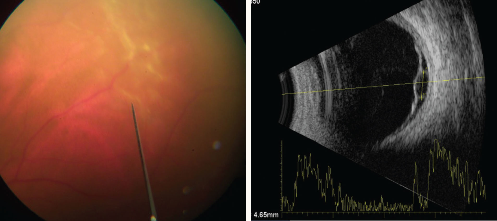 Retinal detachment in a patient with a solitary tubercular granuloma (left) on B-scan ultrasonography (right).