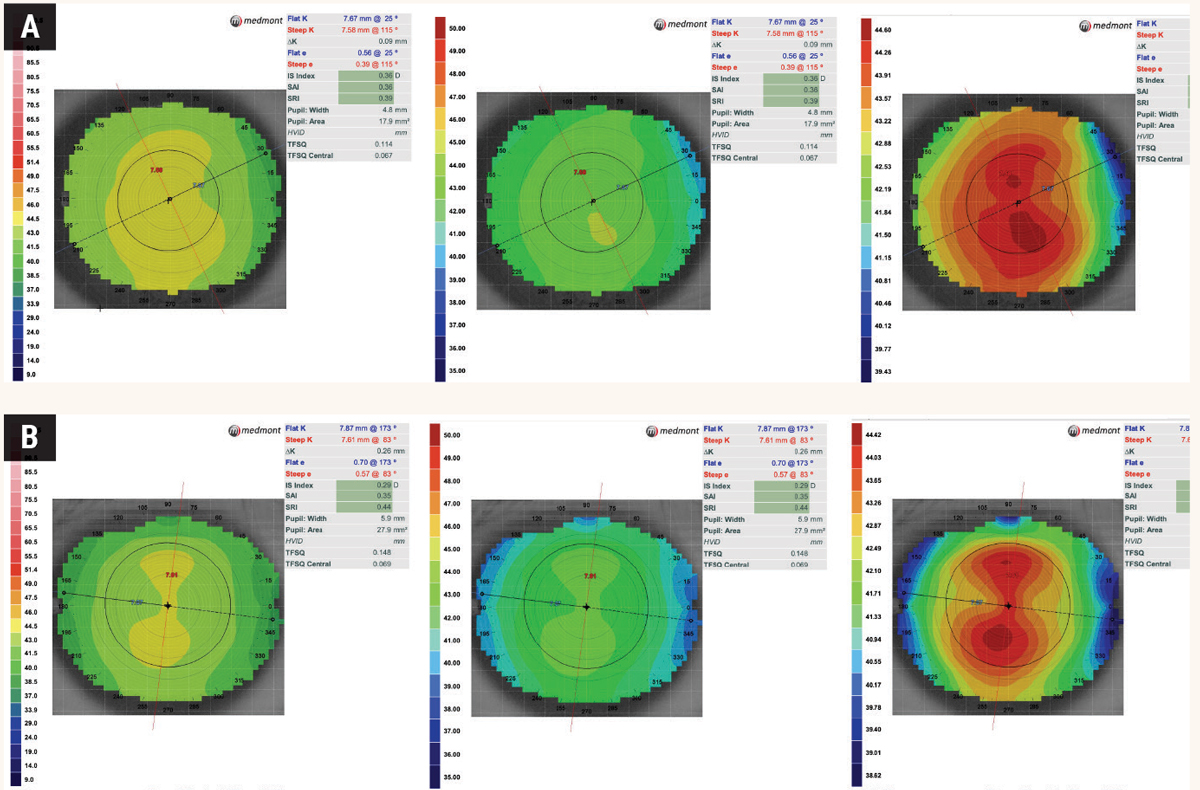 Fig. 1. Same axial map scan of (A) normal, spherical cornea and (B) regular astigmatic cornea with different scaling: The color scale represents the power in Diopters at each particular point. In (A), the K Scale and Standard Power color maps show a uniform green/yellow pattern compared to a Normalized Power scale, which shows a gradient with multiple colors and a large red area. At first glance, it may be easy to assume that the third topography map is irregular and steep due to the predominantly red presentation. However, the scale setting used maxes out at 44.60 diopters which correlates with the dark red color. In (B), the K scale shows a mild classic, with-the-rule topography pattern but appears spherical in the standard power. The astigmatic pattern is much more pronounced in the Normalized scaling. It is thus important to take note of the scaling range as it is much broader in the standard scale compared to the normalized scale.