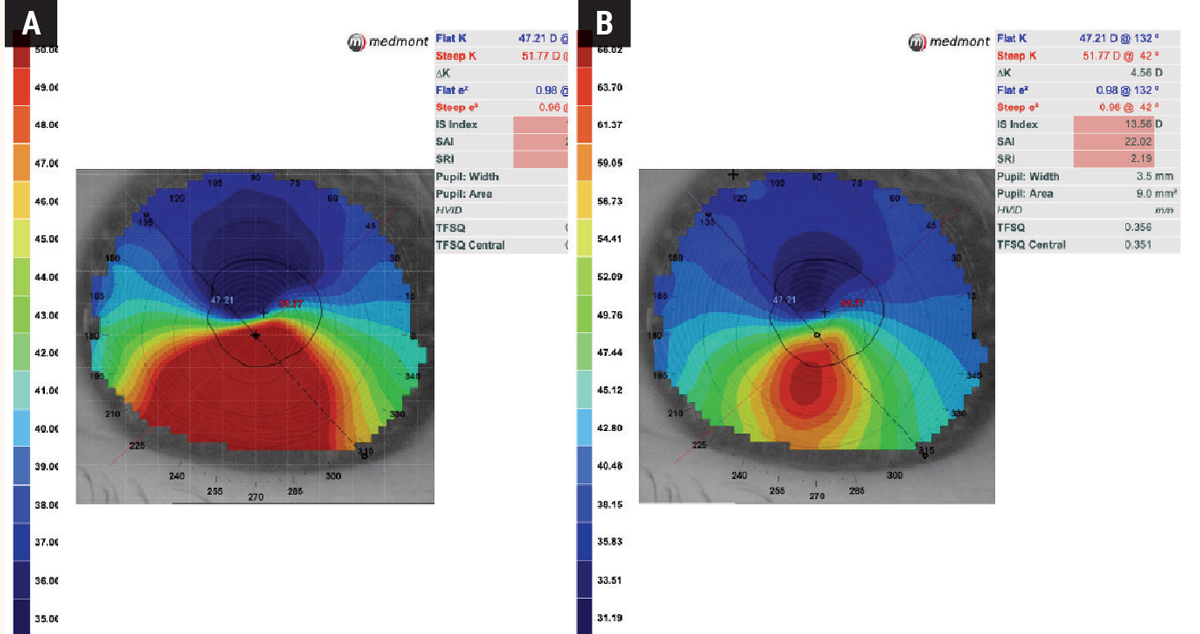 Fig. 2. Same axial map with different scaling in an irregular cornea: Initially using the default Standard Power scaling (A), it is apparent that the patient has keratoconus, but the scale only goes up to 50.00D, while the steep K-reading itself exceeds this value at 51.77D. Once the scale is adjusted to Normalized Power (B), the map reveals a steeper and more condensed cone compared with the Standard Power scale.