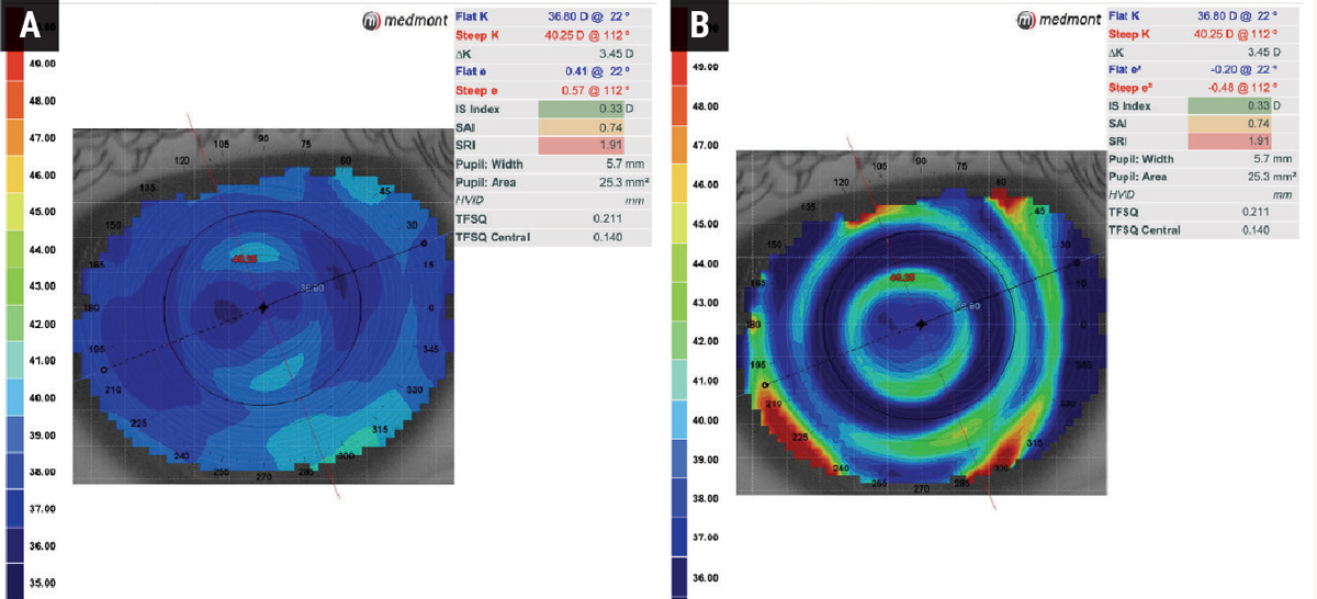 Fig. 4. Axial (A) and tangential (B) power maps of a patient wearing a multifocal soft lens for myopia control. The tangential map provides a detailed overview of the lens centration.