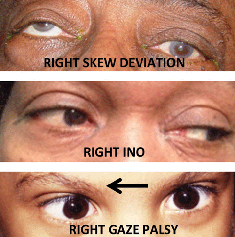 Ocular tilt reaction and skew deviation
