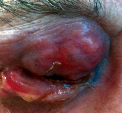 Presented here is an advanced infiltrating eyelid malignancy.
