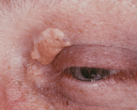 Shown here is an example of an xanthelasma. 