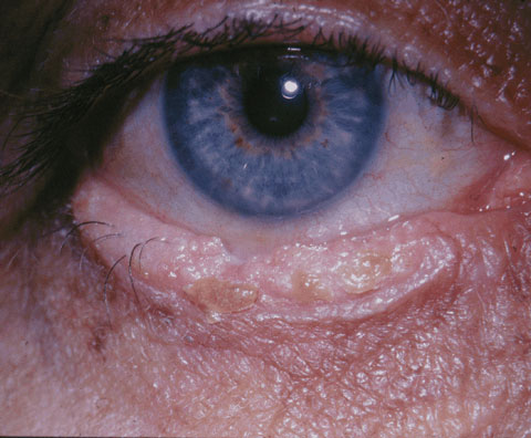 Squamous cell carcinoma.