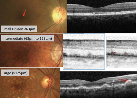 Fig. 1. Fundus photography with corresponding OCT images of small, intermediate and large drusen.