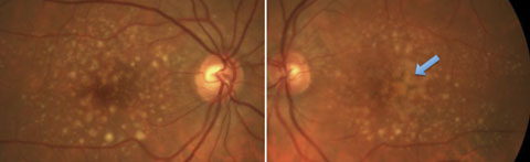 Fig. 2. Both large drusen and pigmentary abnormalities in a patient with a high risk for conversion to advanced AMD.
