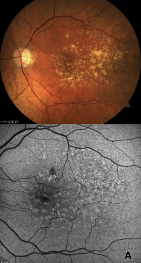 Fig. 5a. FAF more easily highlights early GA formation that is less detectable in fundus examination. 
