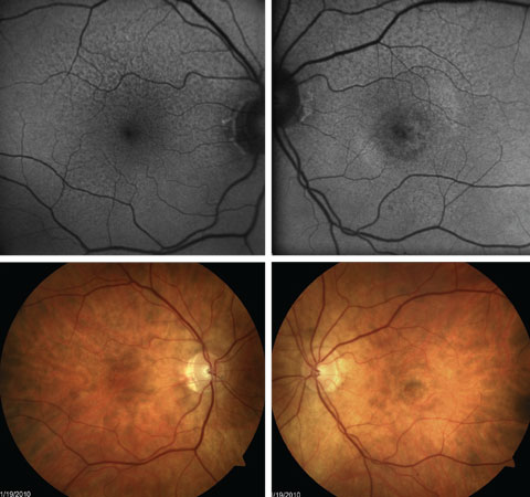 Fig. 6. FAF shows greater extent of RPE abnormality with extrafoveal RPD than is easily seen with fundus photography. This patient also has presence of central CNV OS.