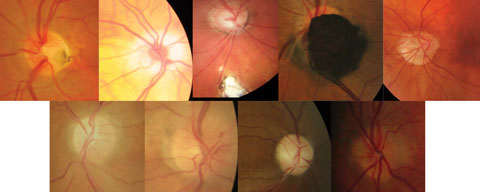 Fig. 1. Collage of non-glaucomatous optic neuropathies. Top (left to right): ONH pit, hypoplastic nerve, ONH/retinal coloboma, melanocytoma, malinsertion. Bottom (left to right): Sectoral pallor, papillitis, optic atrophy, ONH drusen.