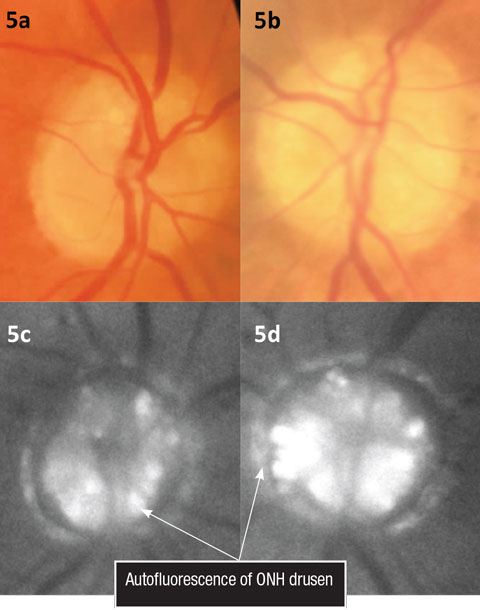 Figs. 5a and 5b. Color fundus photos illustrating ONH drusen. Figs. 5c and 5d. Fundus autofluorescence of the optic nerves.