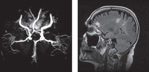 This patient presented emergently with a complaint of three isolated instances of “blue-colored shadows” that transiently and incompletely blocked the vision of the right eye for five minutes at a time. At left, her MRA revealed severe stenosis of the right internal carotid artery (ICA), and she was diagnosed with amaurosis fugax and right hemispheric subacute CVA secondary to severe right ICA stenosis. At right, imaging also showed two restricted diffusion foci located within the right posterior parietal-occipital junction, consistent with a subacute infarct. Photos: Michael Trottini, OD, and Michael DelGiodice, OD