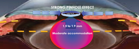 Fig. 3. Liquid Vision drops use aceclidine to create a strong pinhole effect, while tropicamide regulates accommodation. The combination and ratio of drugs aids both near and distance vision. Image: Presbyopia Therapies