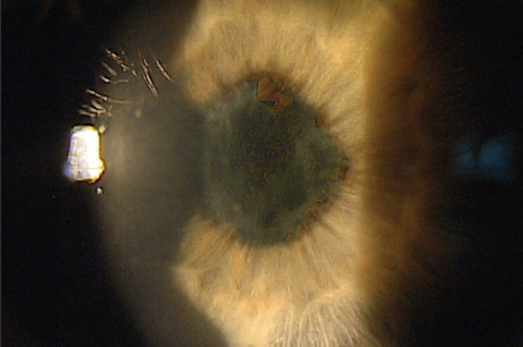 Fig. 4. According to Giovanna Benozzi, MD, chronic dosing of pilocarpine alone may lead to posterior synechiae and a fixed pupil, as shown here. Diclofenac, used in Benozzi Method, is intended to prevent this complication. Photo: Walt Whitley, OD, MBA, and John Sheppard, MD, MMsc