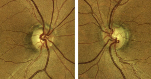 Figure 1. Right and left eyes of the patient presented in Case 1.