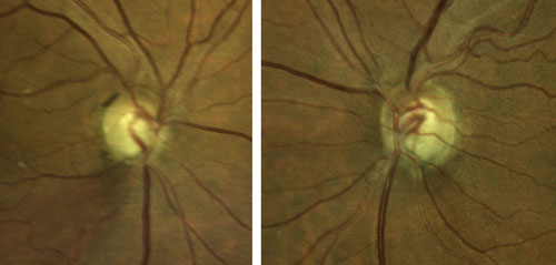 Figure 4. Optic nerves of the patient presented in Case 2.