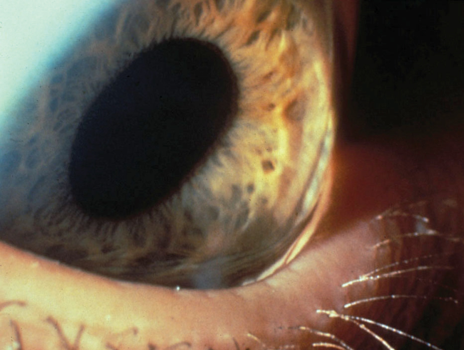 Fig 2. Advanced keratoconus with Munson's sign. Despite disease severity, note the otherwise clear cornea with no other discernable clinical signs via slit lamp examination.