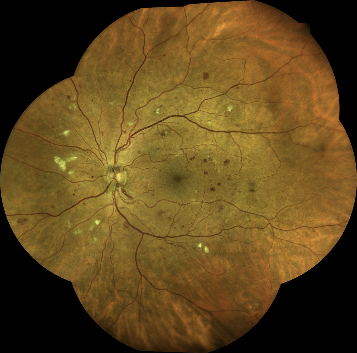 Figure 2. Moderate nonproliferative diabetic retinopathy with microaneurysms, dot/blot hemorrhages, hard exudates, cotton wool spots, and intraretinal microvascular abnormalities. Image courtesy of Steven Ferrucci, OD