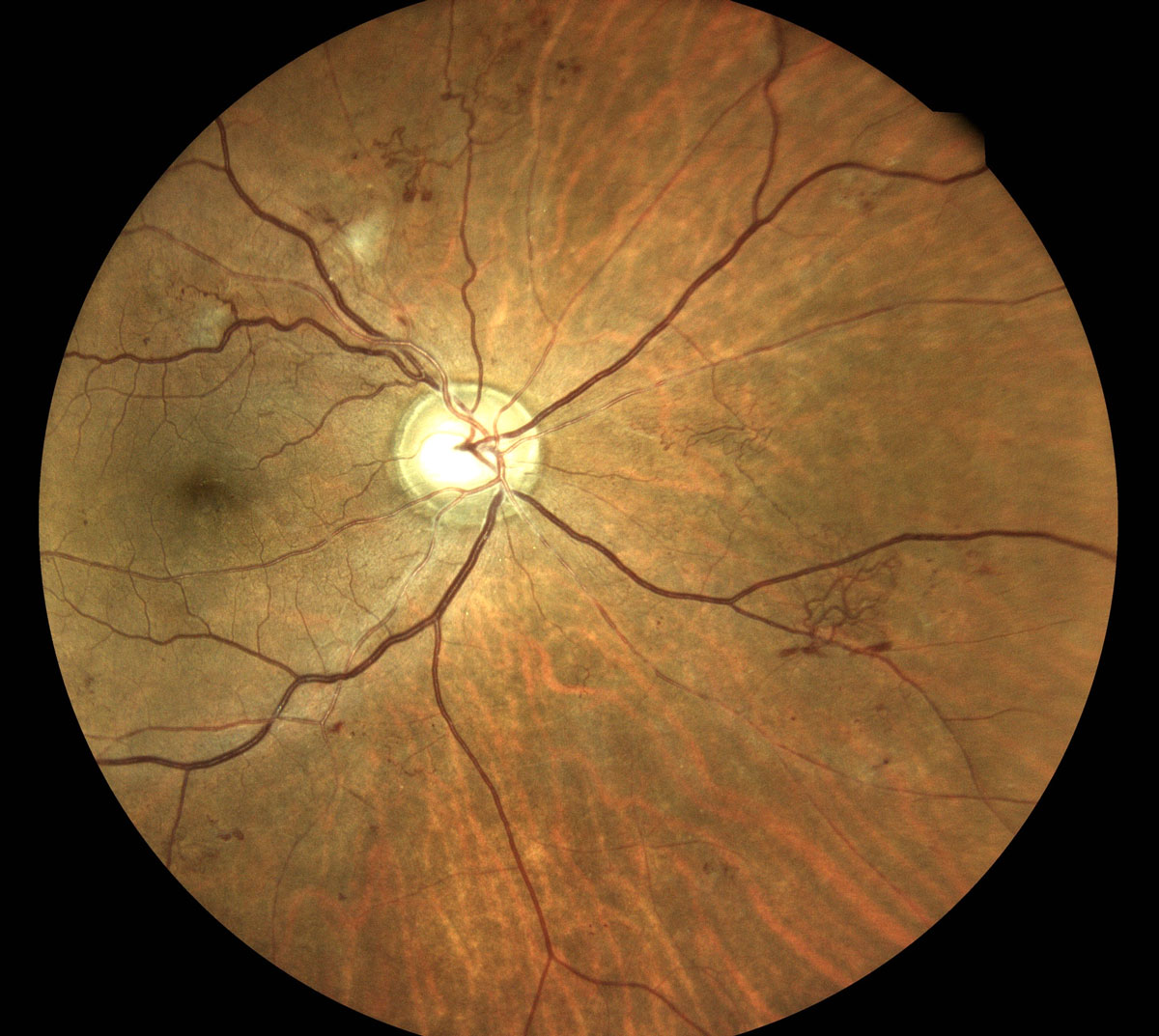 Figure 3. Proliferative diabetic retinopathy with neovascularization. Image courtesy of Steven Ferrucci, OD