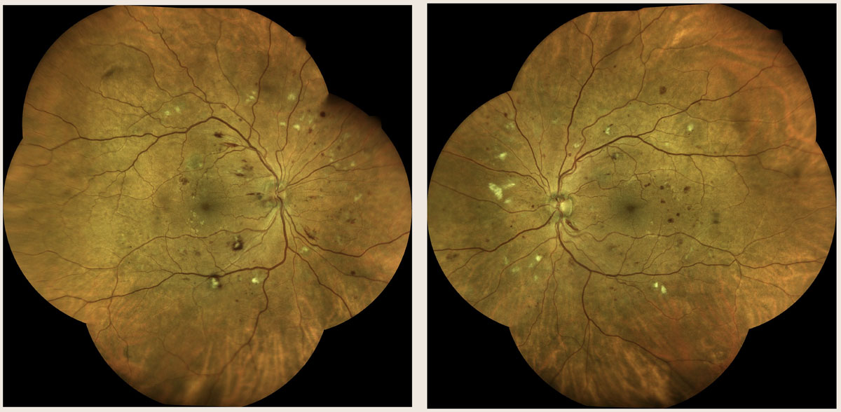 Figure 8. Fundus photographs of the patient presented in the case. Images courtesy of Steven Ferrucci, OD 