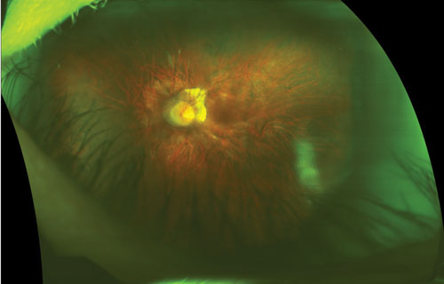 While high levels of myopia have greater risk for pathologic changes, even low levels of myopia (-0.75 to -3.00D) are associated with increased risk for retinal disease.
