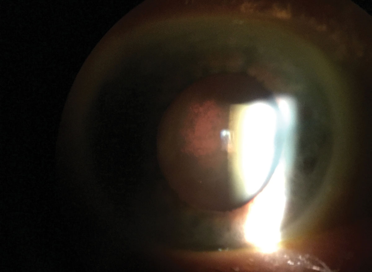 Posterior subcapsular cataracts, such as this one in retroillumunation, are not always part of the nornal aging process.