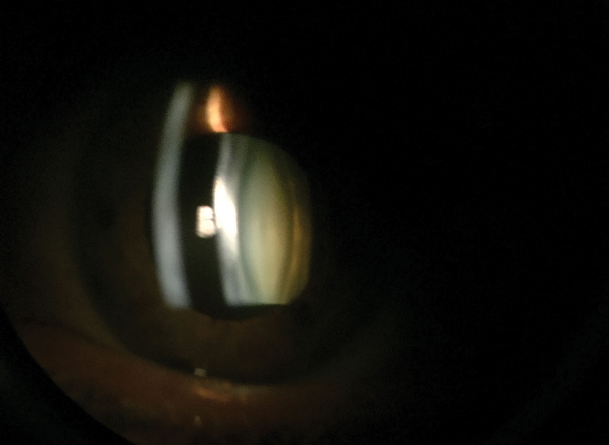 Parallelepiped slit lamp examination reveals a nuclear sclerotic cataract.