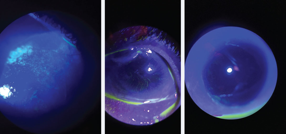 At left, corneal staining in patient with early LSCD. Note the stippled, elongated, almost pill like shape to the areas of staining. Middle, traditional whorl pattern staining with fluorescein. Note that the pattern starts at the limbus and begins to circle towards the apex of the cornea. At right, subtle late staining inferior and temporal with fluorescein of conjunctival cells on cornea in patient with LSCD.