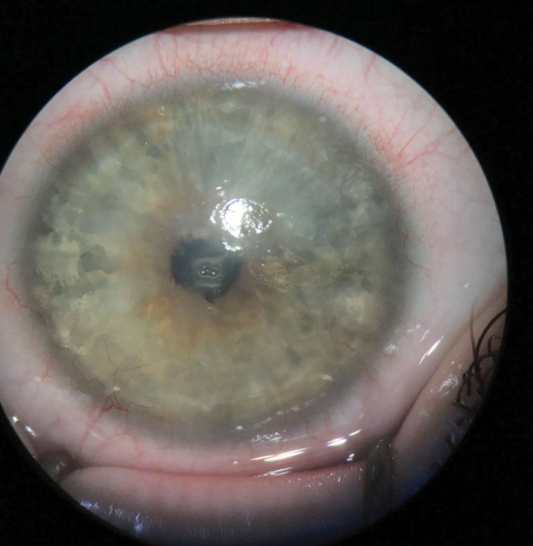 A moderate LSCD patient pre-operative for Ir-CLAL. Note the dullness and irregularity of the central cornea where the epithelium has begun to be replaced with conjunctival cells.