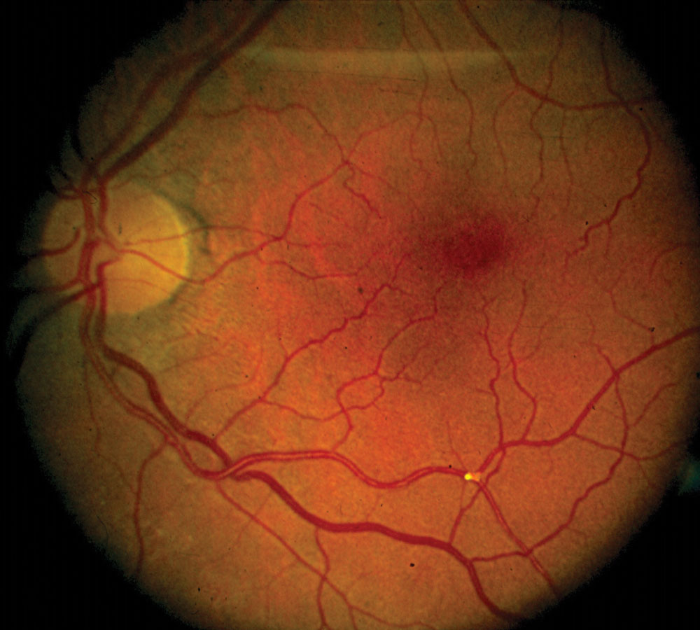 Fig. 3. Retinal embolus with vascular tortuosity.