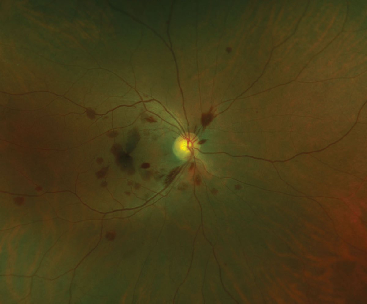Fig. 4. Central retinal vein occlusion associated with systemic hypertension.