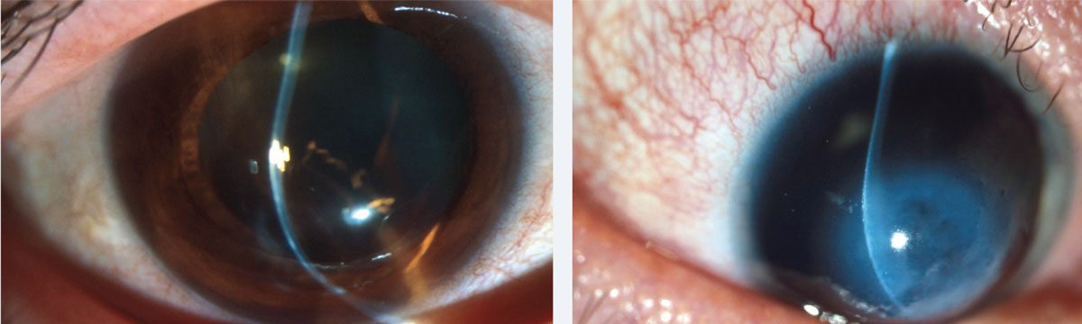 At left, inferior steepening of the cornea associated with thinning at 2mm from the limbus is the hallmark of PMD. At right, corneal hydrops in a patient with Down syndrome and advanced keratoconus.