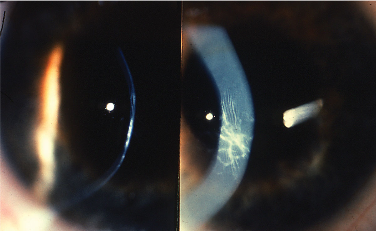 Apical scarring, together with Vogt striae, is a sign of moderate keratoconus.