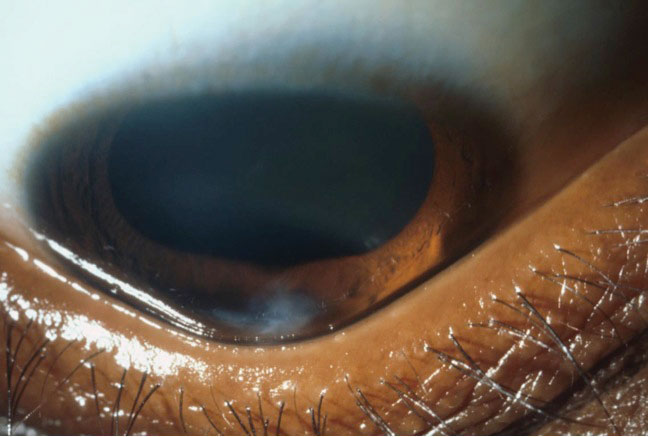 The triangular deformation of the lower eyelid contour when looking down, or Munson’s sign, is an indicator of advanced keratoconus.
