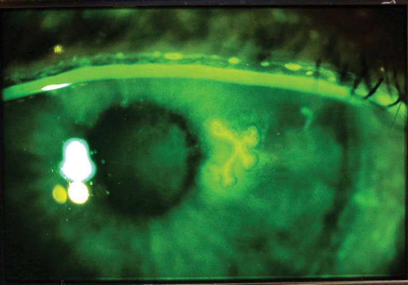 Herpes simplex dendriform keratitis, with the corneal lesion highlighted with fluorescein dye.