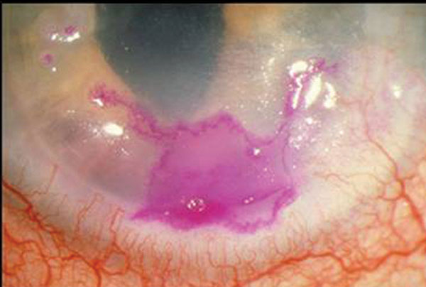 Herpes simplex geographic keratitis, with the corneal lesion highlighted by rose bengal dye. Note that the geographic lesion exhibits border dendriform branches.