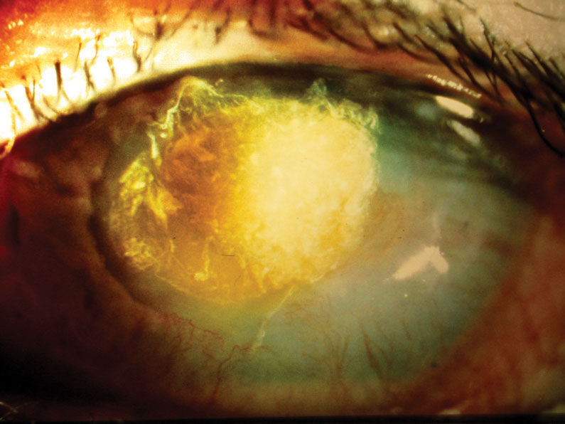 A female patient in her late 20s developed Candida superinfection subsequent to culture-positive bacterial keratitis, which was initially responsive to a fortified topical antibiotic. Once the fungal infection was eliminated, the resulting scar required a corneal transplant, restoring acuity to 20/25.