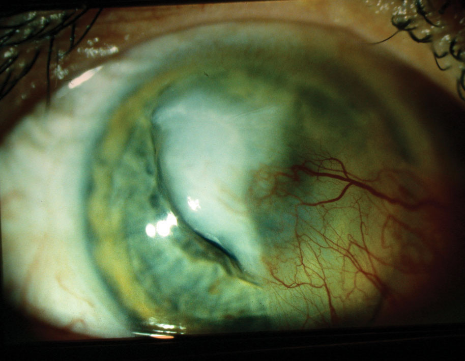 A large central corneal infiltrate/ulcer with adjacent pre-existing pterygium, aggravated by culture-positive Streptococcus infection. 