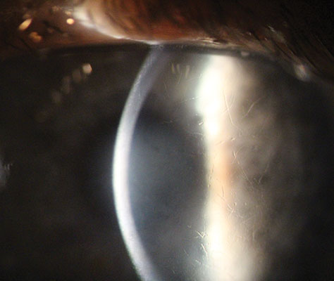 Lattice dystrophy on high magnification. Note the progressive corneal haze.