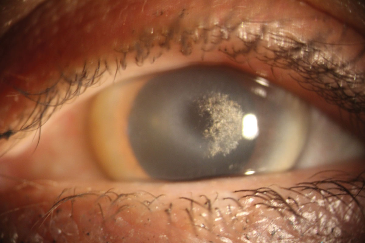 Schnyder corneal dystrophy with an overlying scleral contact lens.