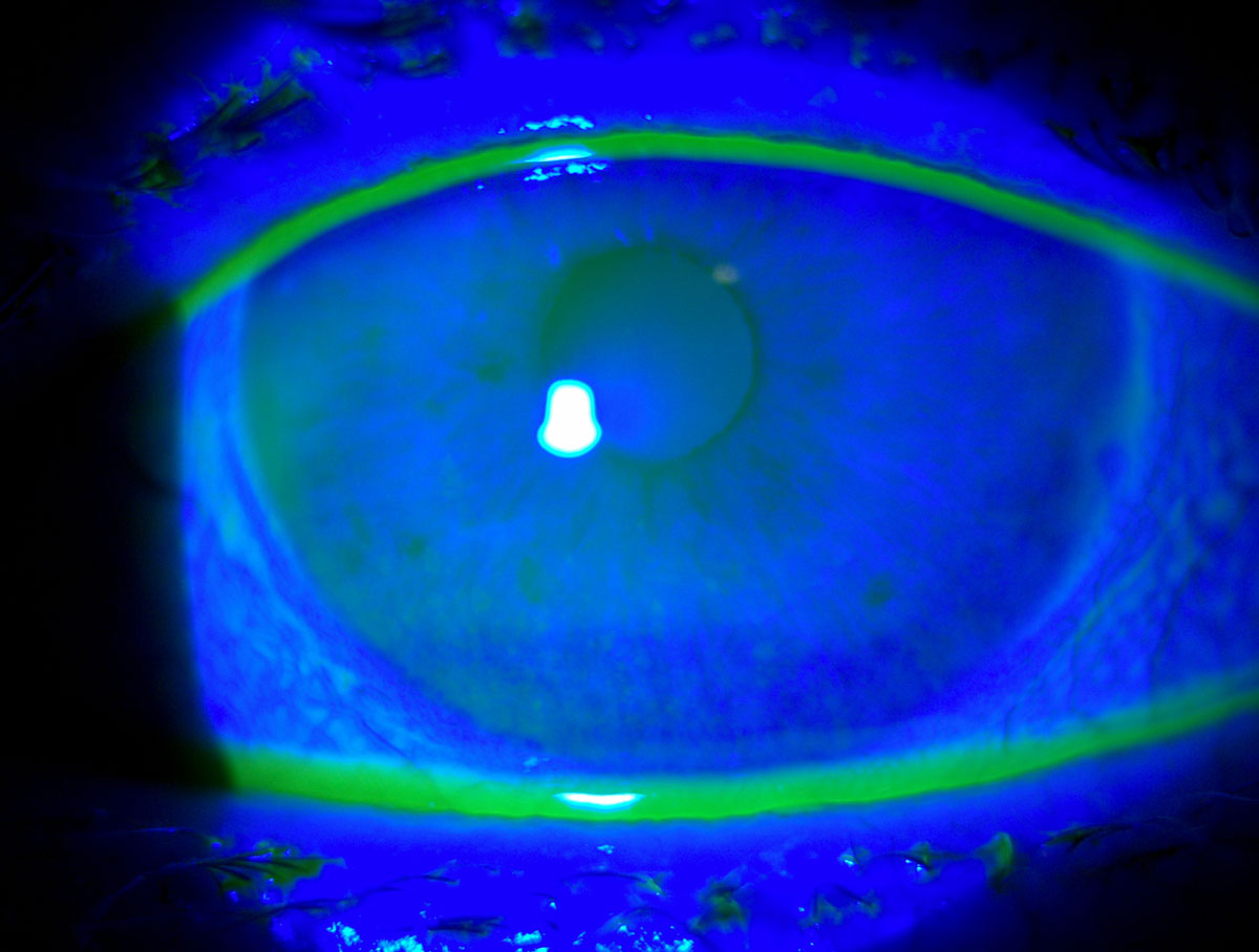 Fig. 2. Corneal punctate epithelial erosions viewed with sodium fluorescein and cobalt blue filter.