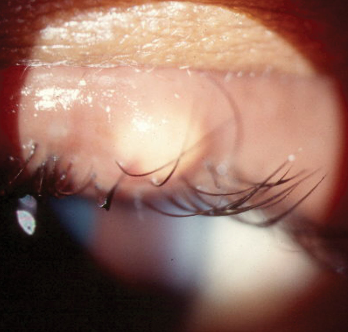 Fig. 1. Localized swelling secondary to an external hordeolum pointing anteriorly through the eyelid skin.
