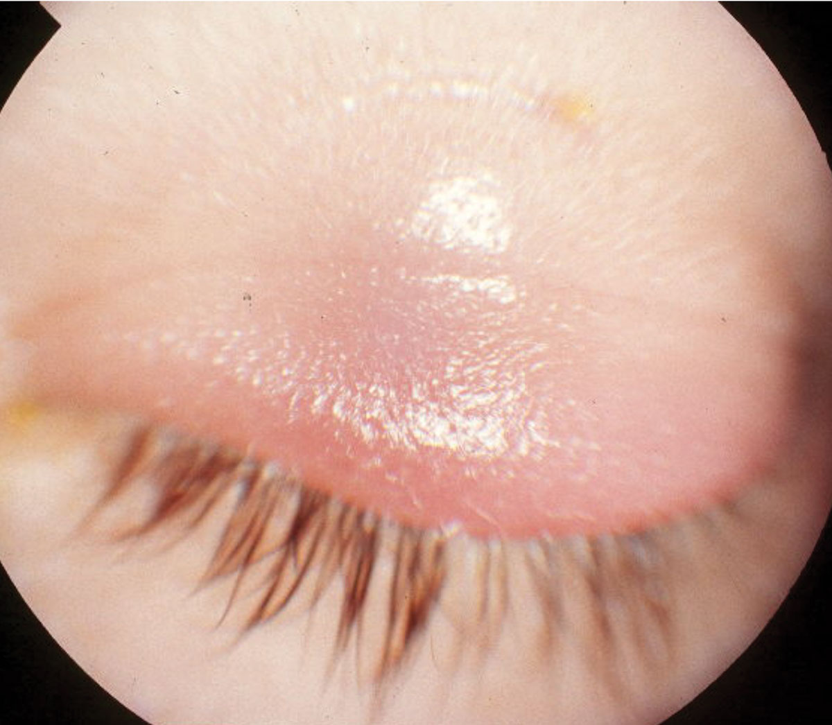 Fig. 4. This child had swelling of the upper eyelid in a case of preseptal cellulitis, which can generally be managed with broad- spectrum oral antibiotics.