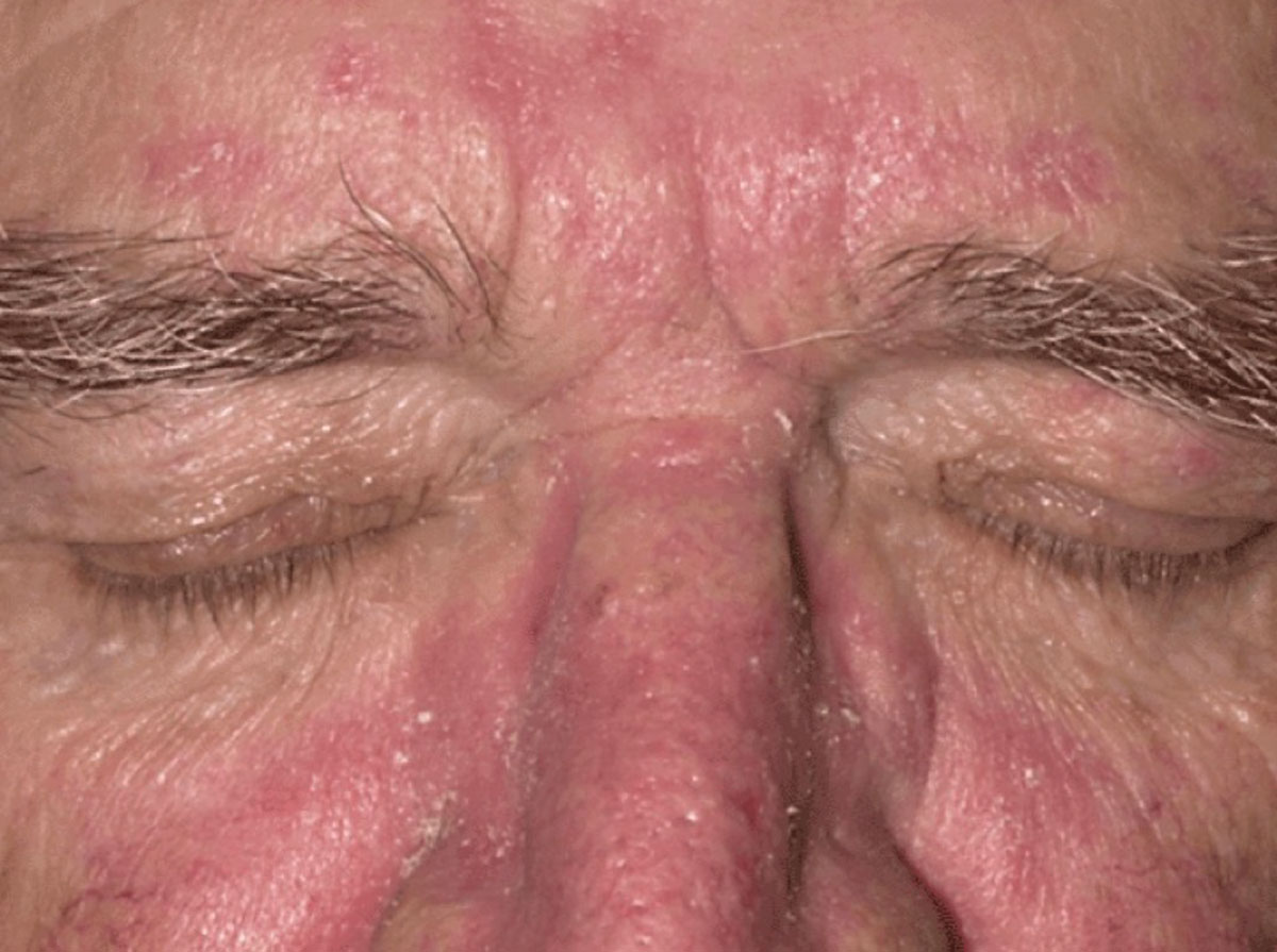 Fig. 5. This patient presented with facial features of rosacea, including redness of the nose and cheeks extending into the forehead.
