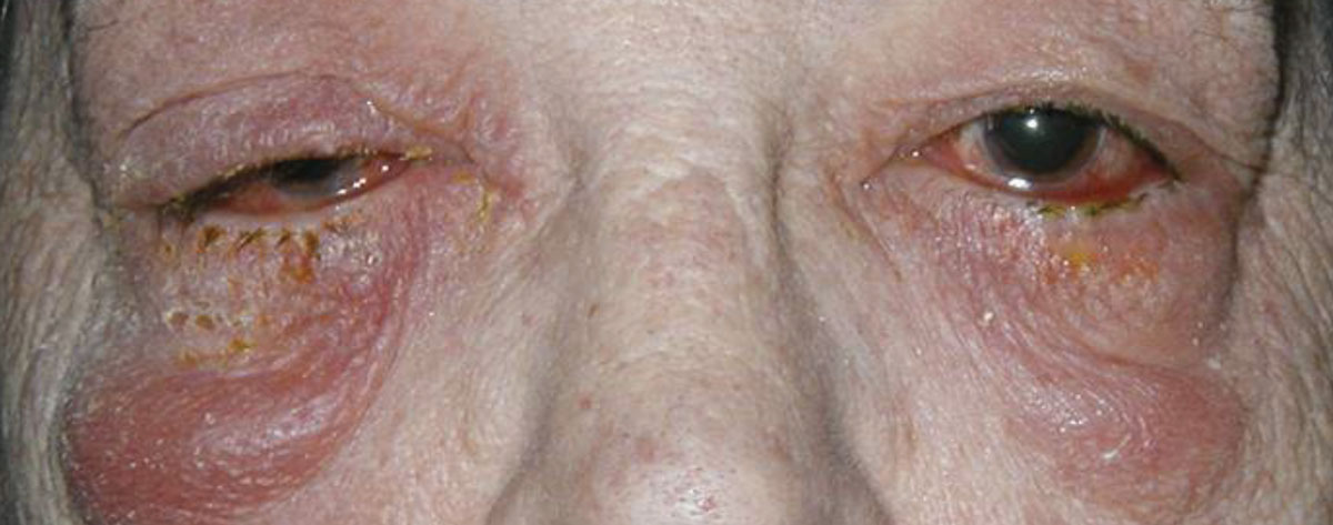 Fig. 6. Oral prednisone was used to manage this patient with contact dermatitis.