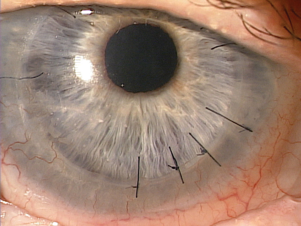 Fig. 2. A full-thickness PKP with several interrupted sutures visible. All of the corneal nerves are transected when a PKP is performed. Photo: Jeffrey Sonsino, OD. 