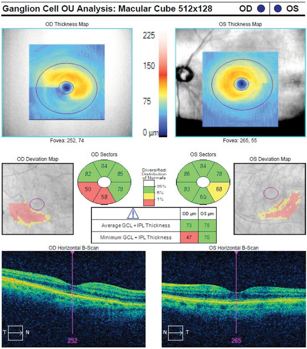 Fig. 2. This macular ganglion cell analysis scan shows the characteristic wedge-shaped loss in the inferior temporal macular vulnerability zone. Note the squeegee sign more pronounced in the right eye. 